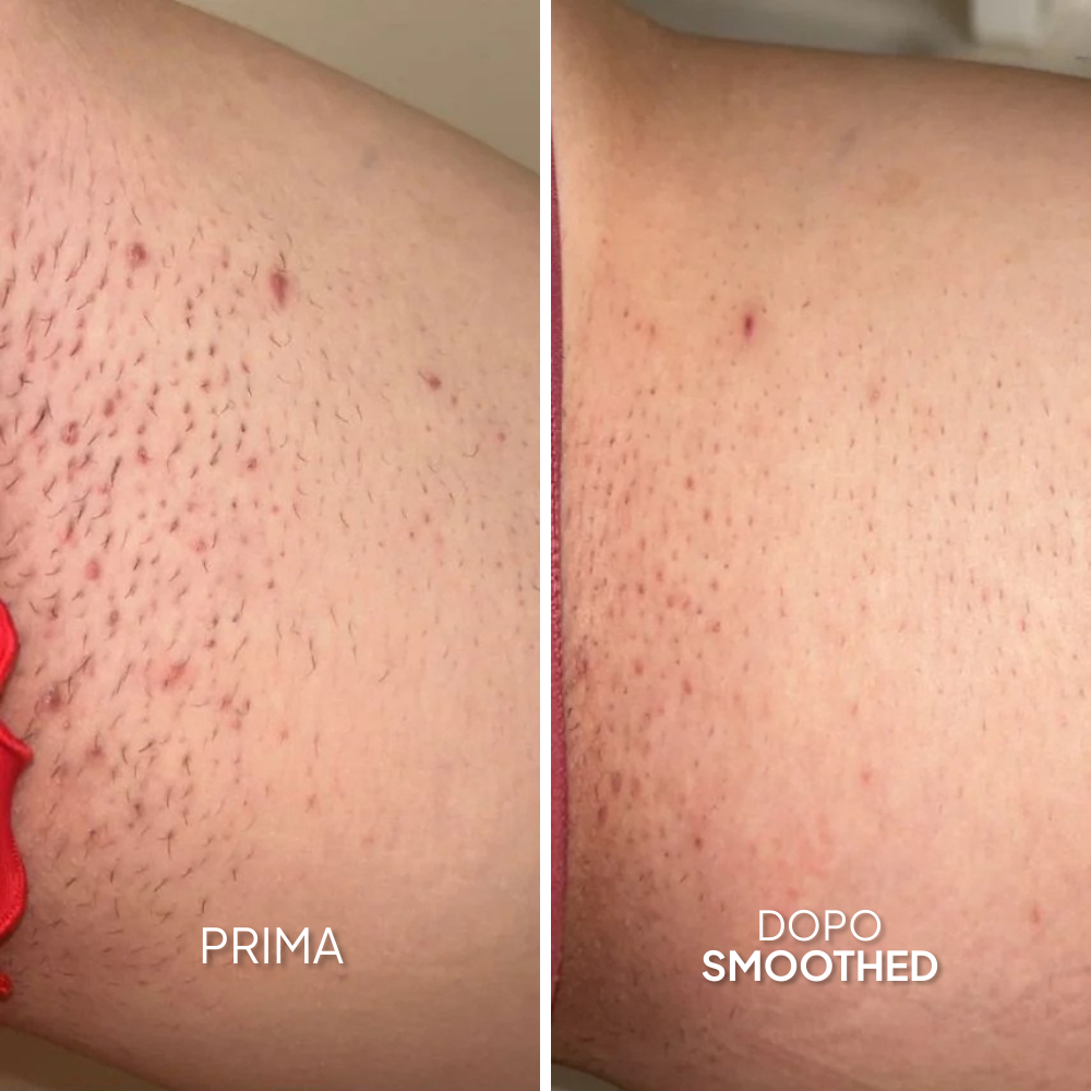 Smoothing Solution - Trattamento Contro i Peli Incarniti